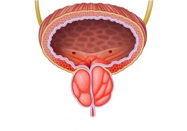 Entzündung vun der Prostata bei Männer