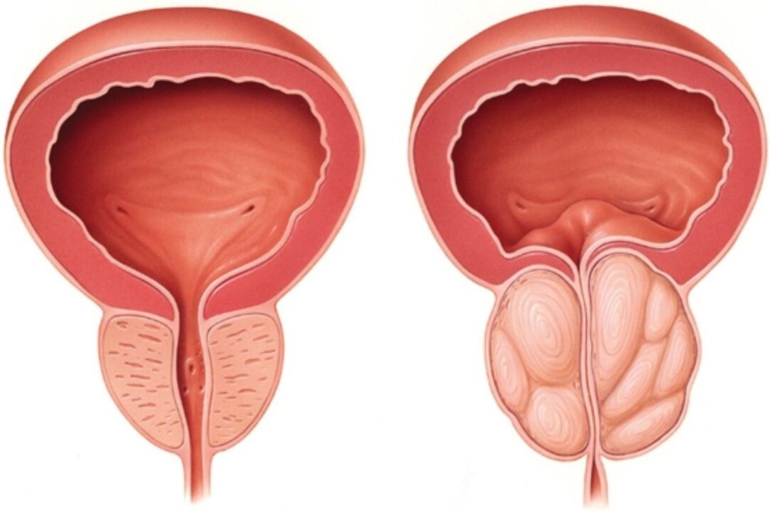 Normal Prostata (lénks) a mat Unzeeche vun Entzündung bei Prostatitis (riets)