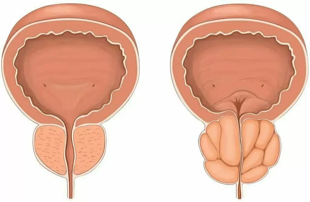 Normal Prostata an Halswéi prostat