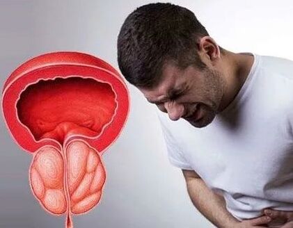 Symptomer vun chronescher Prostatitis zu Männer