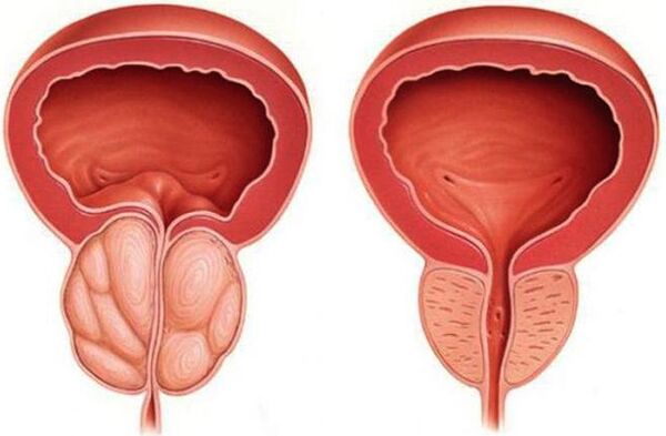 gesond an entzündete Prostata mat Prostatitis